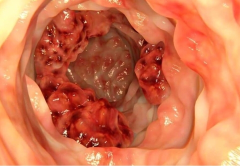 Tổng quan về ung thư ống hậu môn